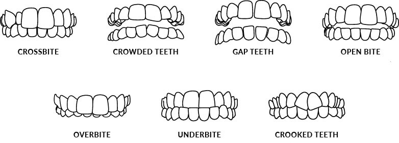 Invisalign treatable cases diagram showing alignment corrections