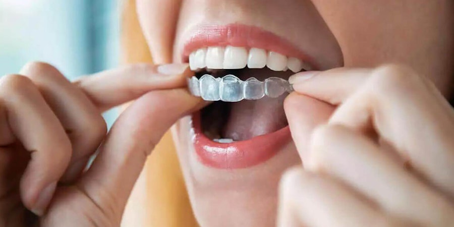Invisalign Clear Aligners: A Complete Guide (Process, Prices & More!)