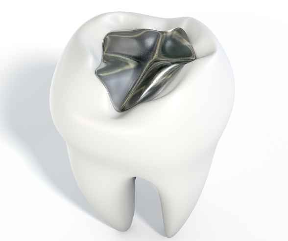 Dental Restoration Procedure